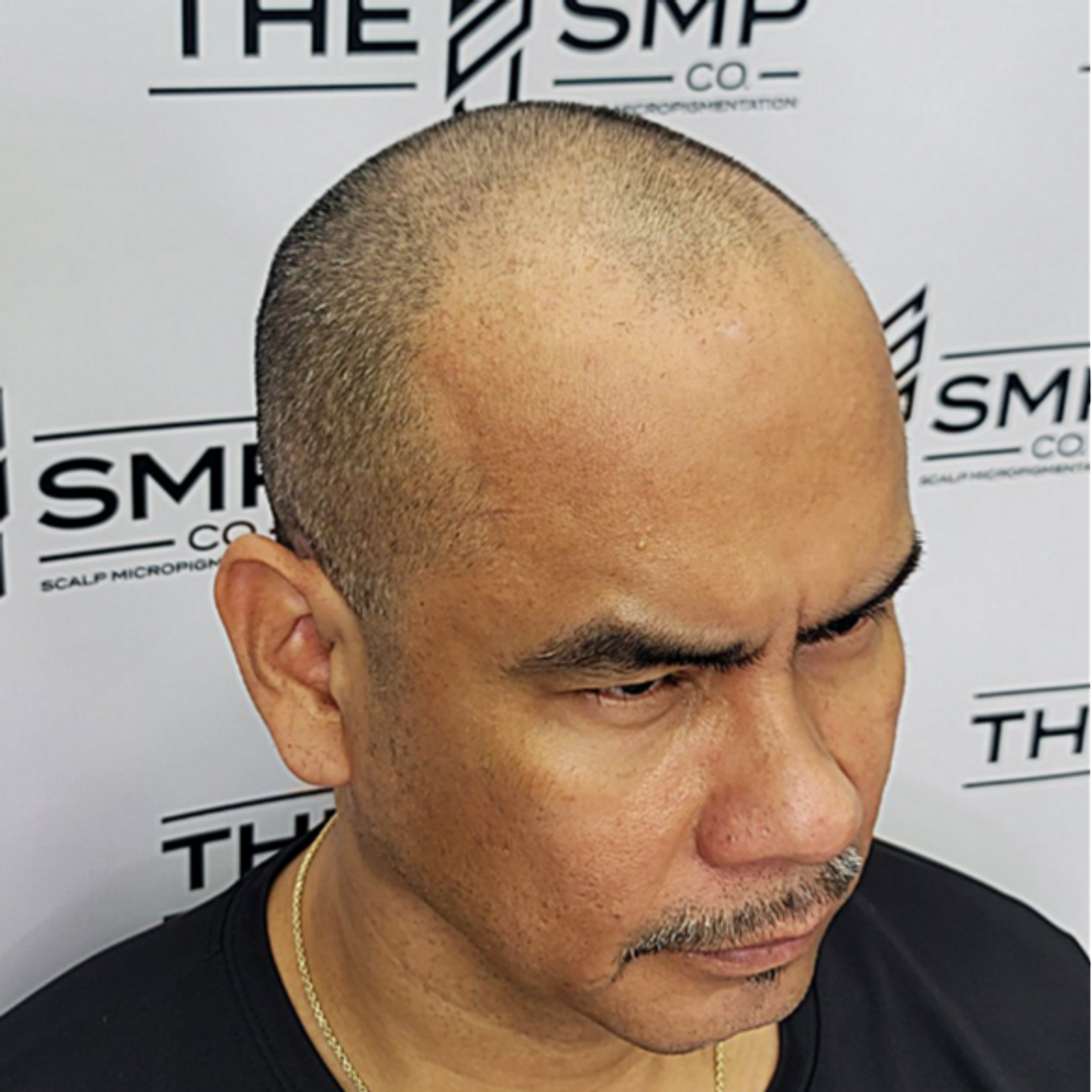 SMPTreatment